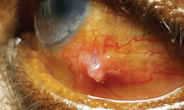 Conjunctival Granuloma: A Fleshy Mass That Almost Always Has a Story Behind It