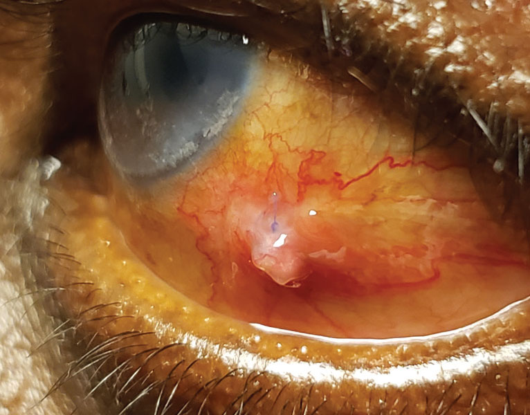 Conjunctival Granuloma: A Fleshy Mass That Almost Always Has a Story Behind It