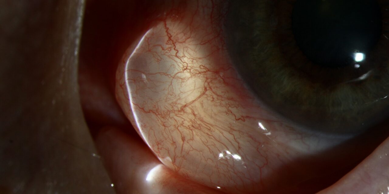 Conjunctival Inclusion Cyst: The Clear Bubble Under the Conjunctiva and How to Deal With It