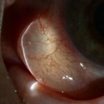 Clinical eye photograph illustrating Conjunctival Inclusion Cyst