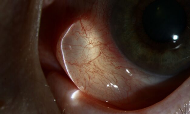 Conjunctival Inclusion Cyst: The Clear Bubble Under the Conjunctiva and How to Deal With It