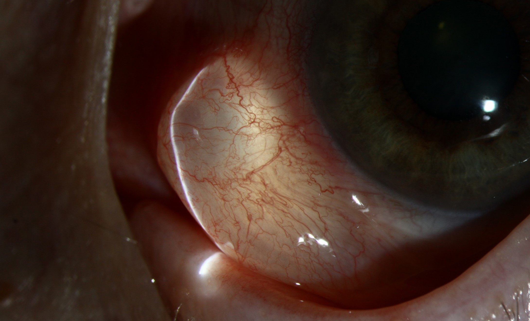 Clinical eye photograph illustrating Conjunctival Inclusion Cyst