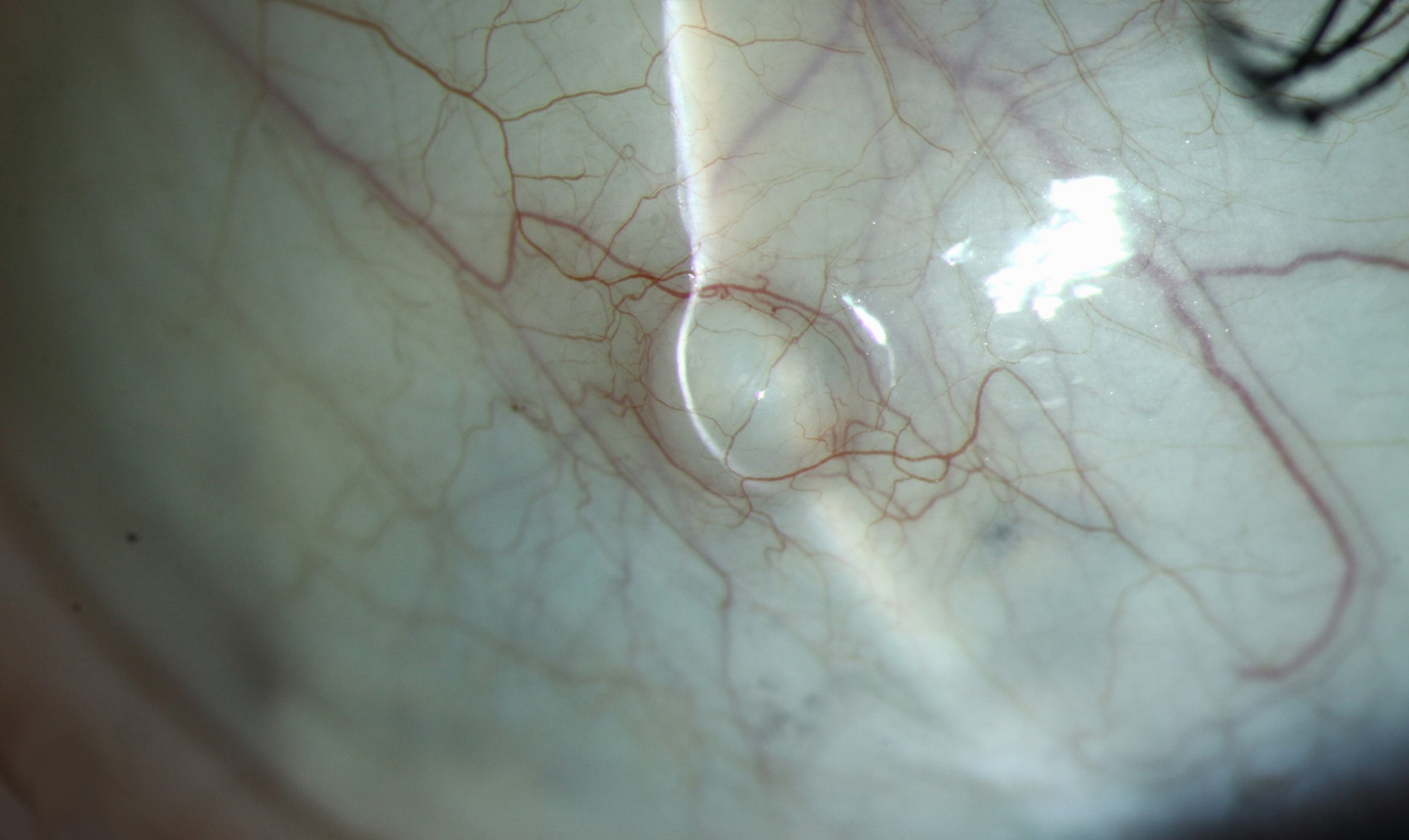Clinical eye photograph illustrating Conjunctival Inclusion Cyst