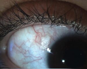 Clinical image illustrating Conjunctival Laceration (Torn Eye Skin)