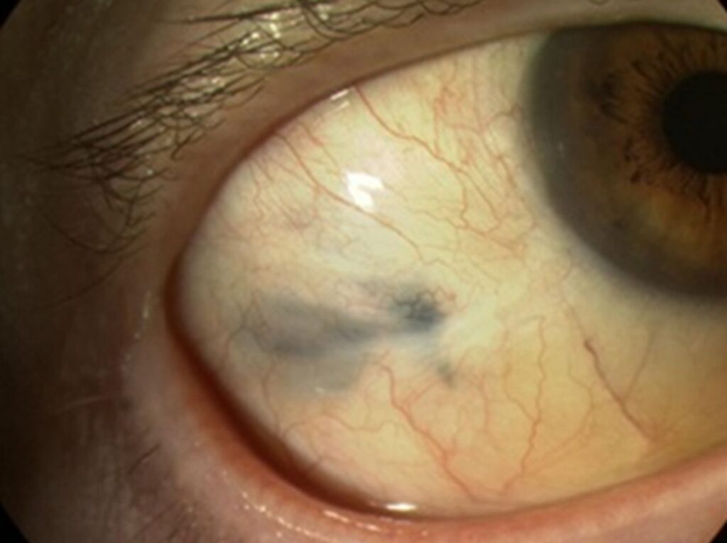 Clinical eye photograph illustrating Conjunctival Melanoma