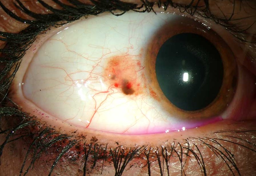 Clinical eye photograph illustrating Conjunctival Melanoma