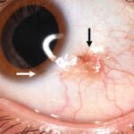Clinical eye photograph illustrating Conjunctival Nevus vs Melanoma