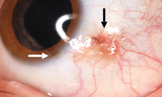Conjunctival Nevus Versus Melanoma: A Different Pigmented Lesion Playbook From the Iris