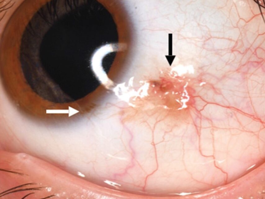 Conjunctival Nevus Versus Melanoma: A Different Pigmented Lesion Playbook From the Iris