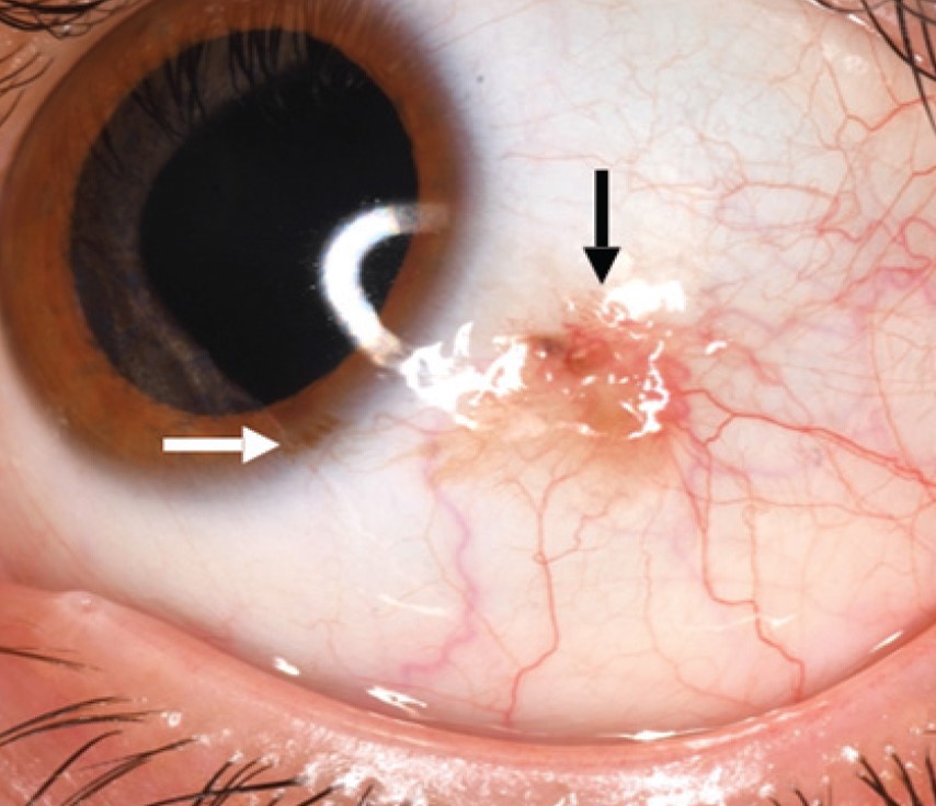 Clinical eye photograph illustrating Conjunctival Nevus vs Melanoma