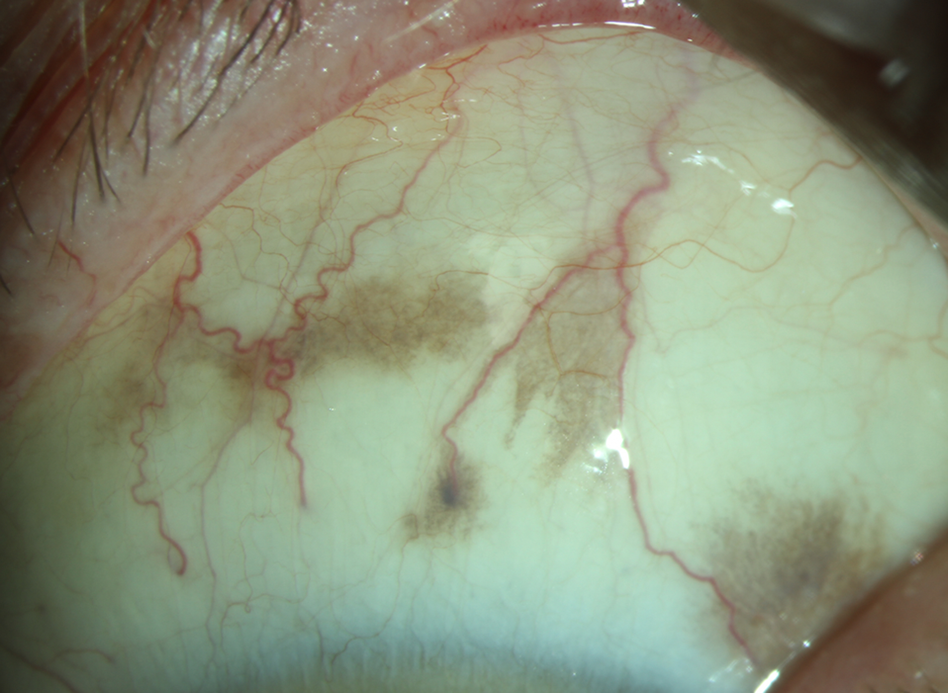 Clinical eye photograph illustrating Conjunctival Nevus vs Melanoma