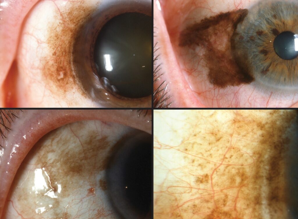 Clinical eye photograph illustrating Conjunctival Primary Acquired Melanosis