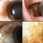 Clinical eye photograph illustrating Conjunctival Primary Acquired Melanosis