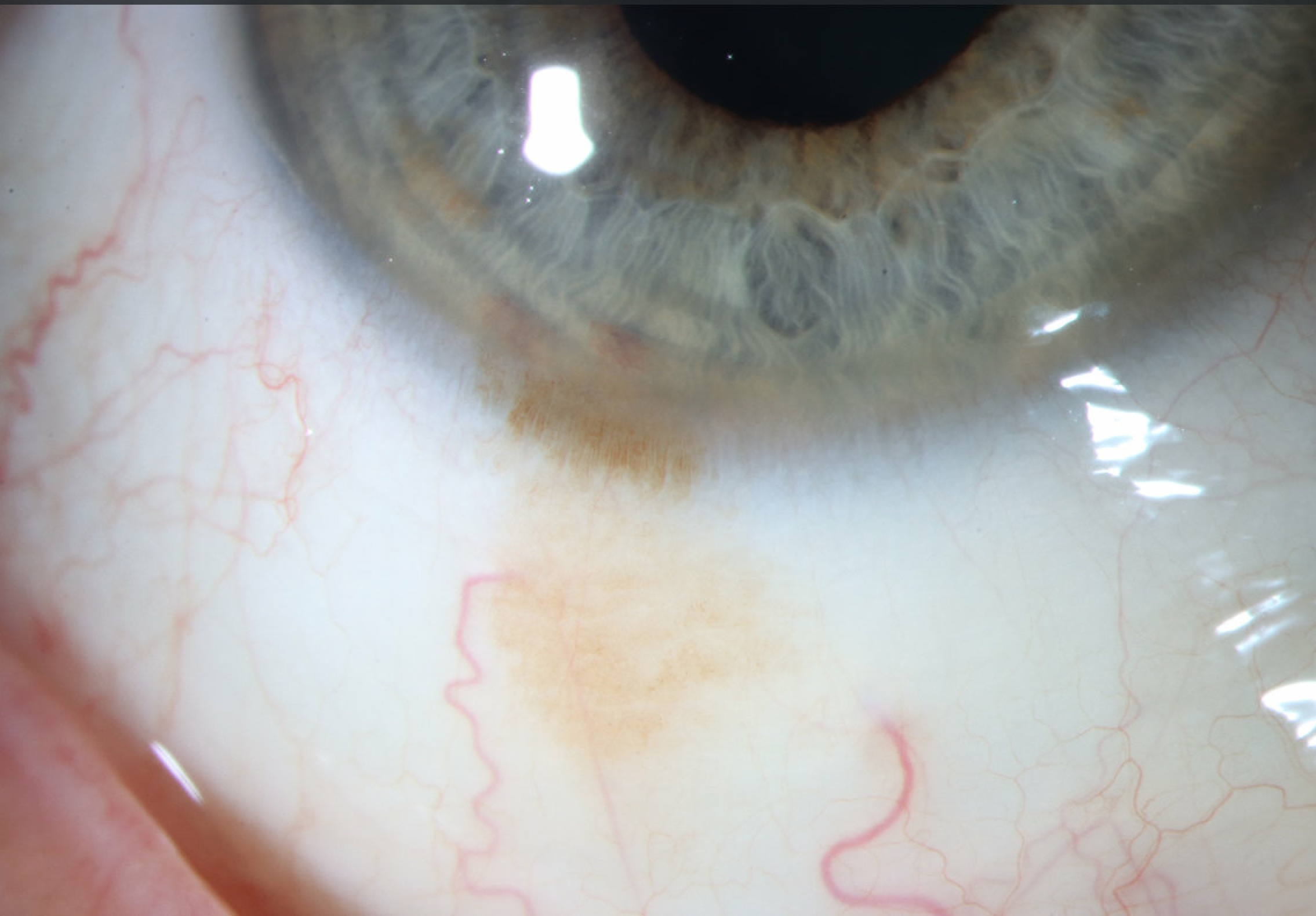 Clinical eye photograph illustrating Conjunctival Primary Acquired Melanosis