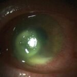 Clinical eye photograph illustrating Contact Lens Acute Red Eye Clare