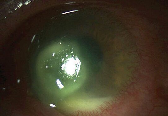 Contact Lens-Induced Acute Red Eye (CLARE): The Angry Eye That Wakes You Up
