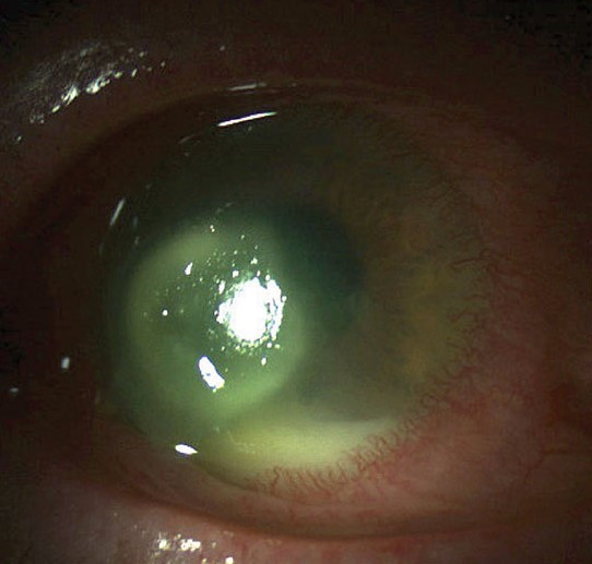 Contact Lens-Induced Acute Red Eye (CLARE): The Angry Eye That Wakes You Up