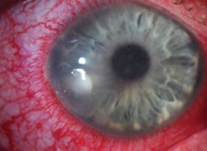 Clinical image illustrating Contact Lens Hygiene (figure 1)