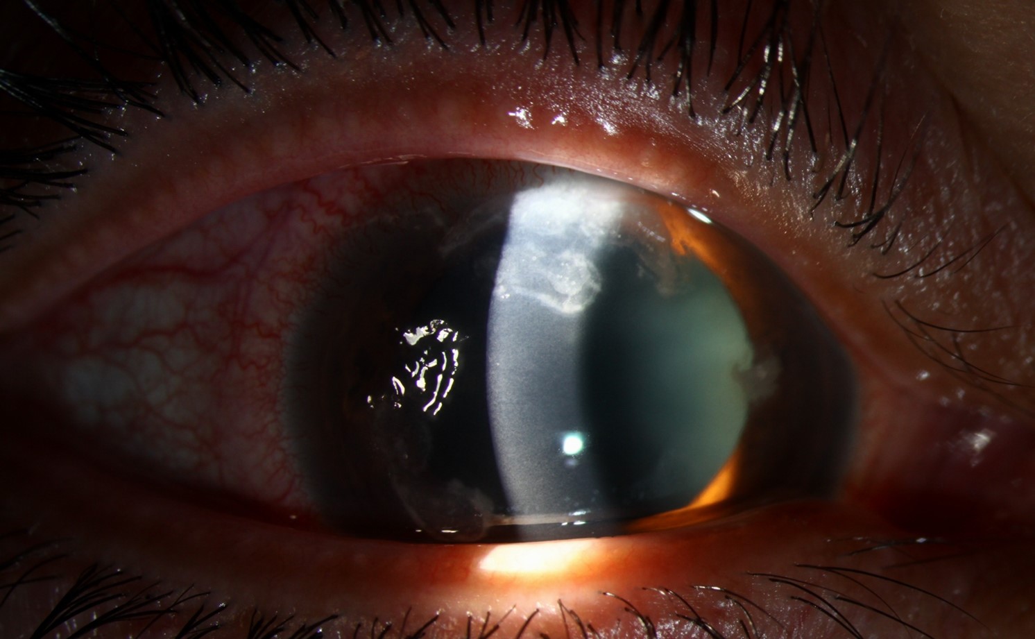 Clinical image illustrating Contact Lens Hygiene (figure 2)