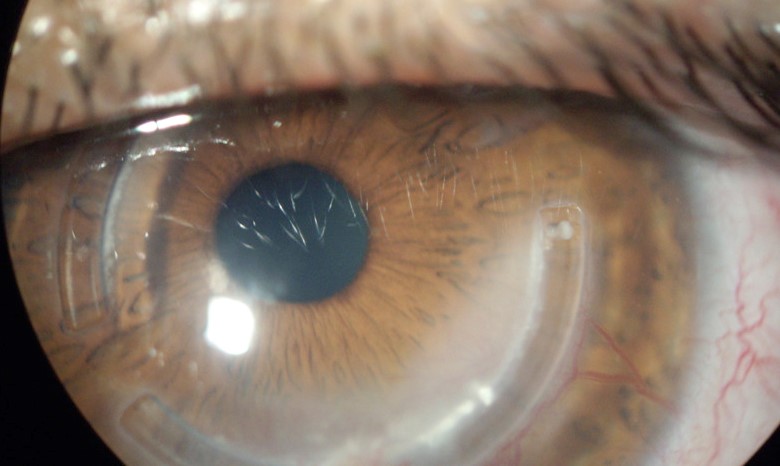 Clinical eye photograph illustrating Contact Lens Hypoxia