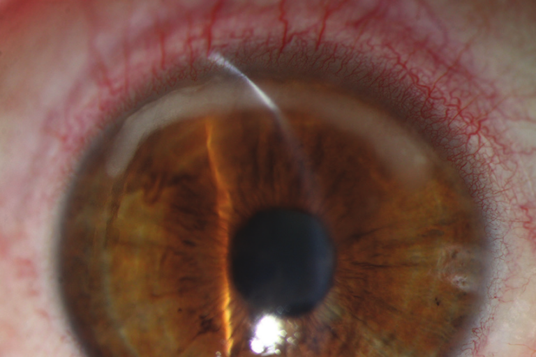Clinical eye photograph illustrating Contact Lens Hypoxia