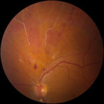 Clinical eye photograph illustrating Copper Silver Wire Arterioles