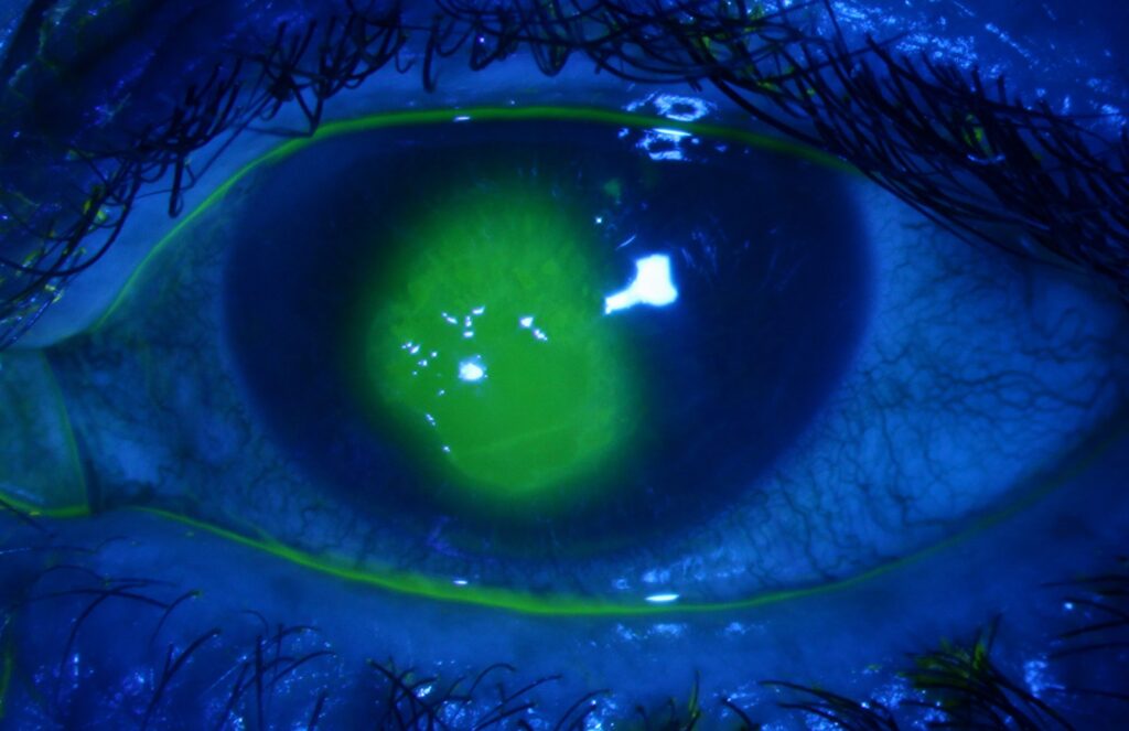 Clinical image illustrating Corneal Abrasion Treatment