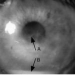 Clinical eye photograph illustrating Corneal Amyloidosis Primary