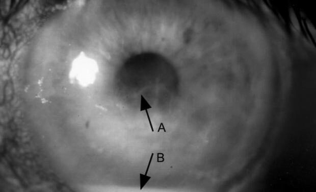 Primary Corneal Amyloidosis: When Protein Deposits Cloud the Stroma Without a Systemic Cause
