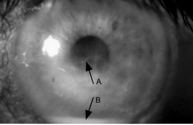 Primary Corneal Amyloidosis: When Protein Deposits Cloud the Stroma Without a Systemic Cause