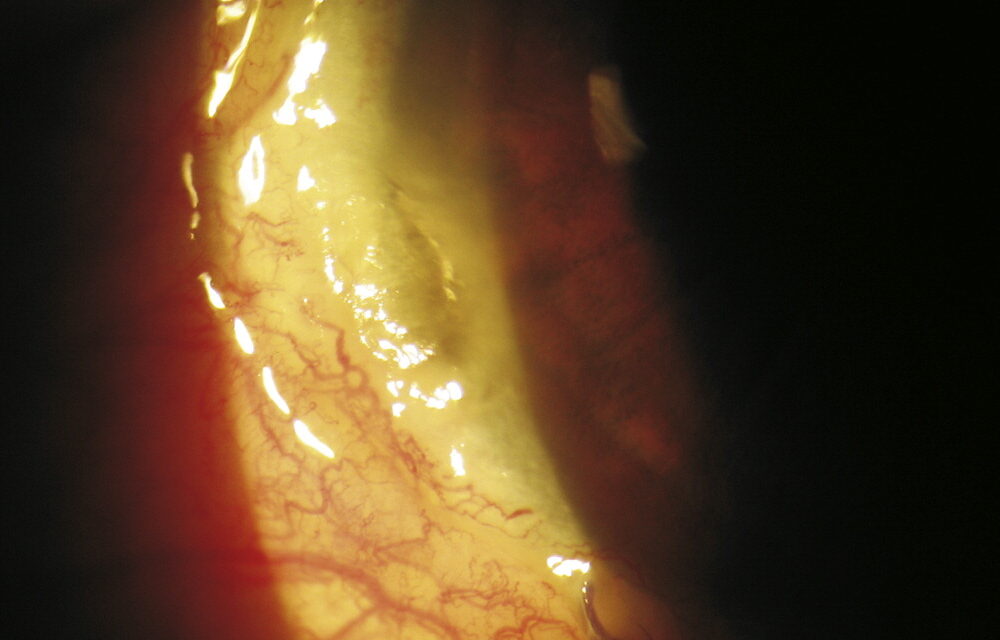 Dellen: The Shallow Corneal Dimple That Forms Beside a Raised Limbal Lesion