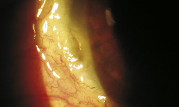 Dellen: The Shallow Corneal Dimple That Forms Beside a Raised Limbal Lesion