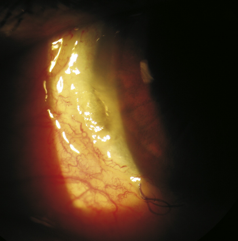 Clinical eye photograph illustrating Corneal Dellen