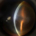 Clinical eye photograph illustrating Corneal Edema Causes Differential