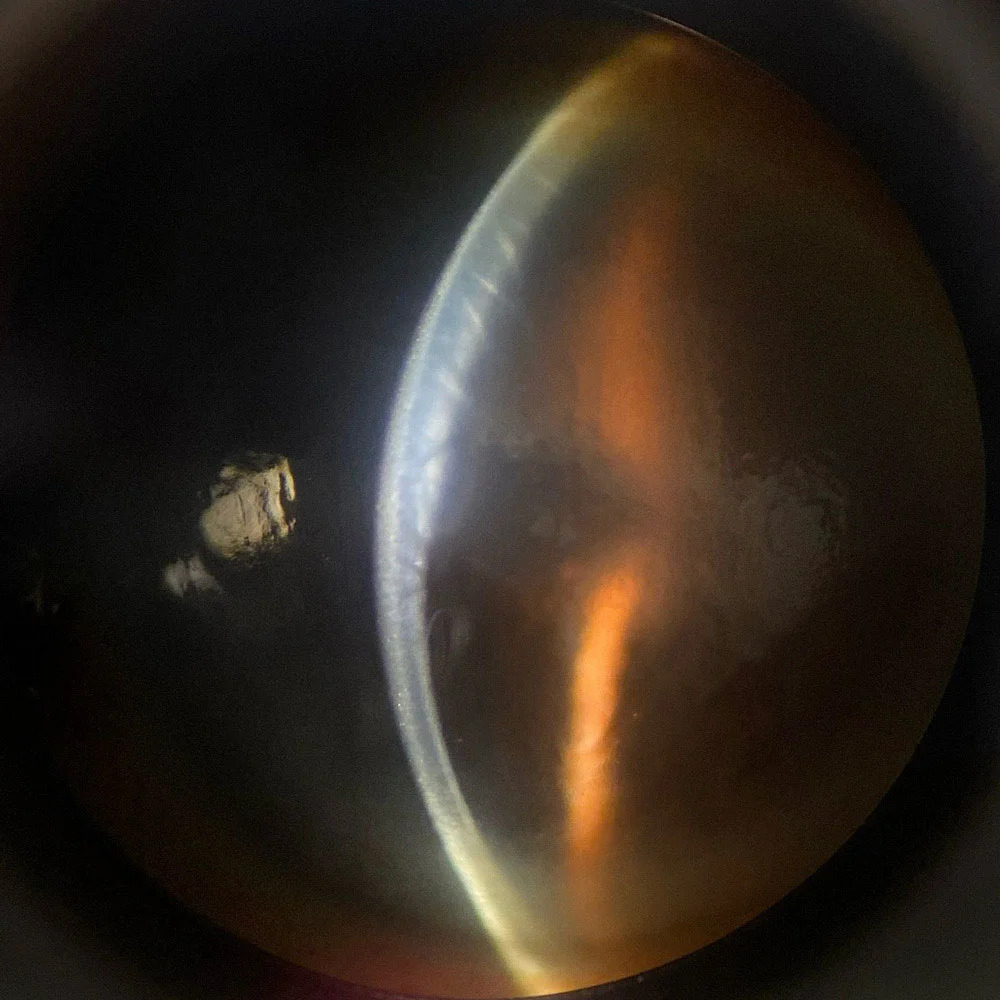 Clinical eye photograph illustrating Corneal Edema Causes Differential