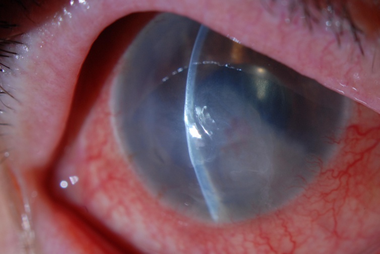 Clinical eye photograph illustrating Corneal Endothelial Cell Therapy