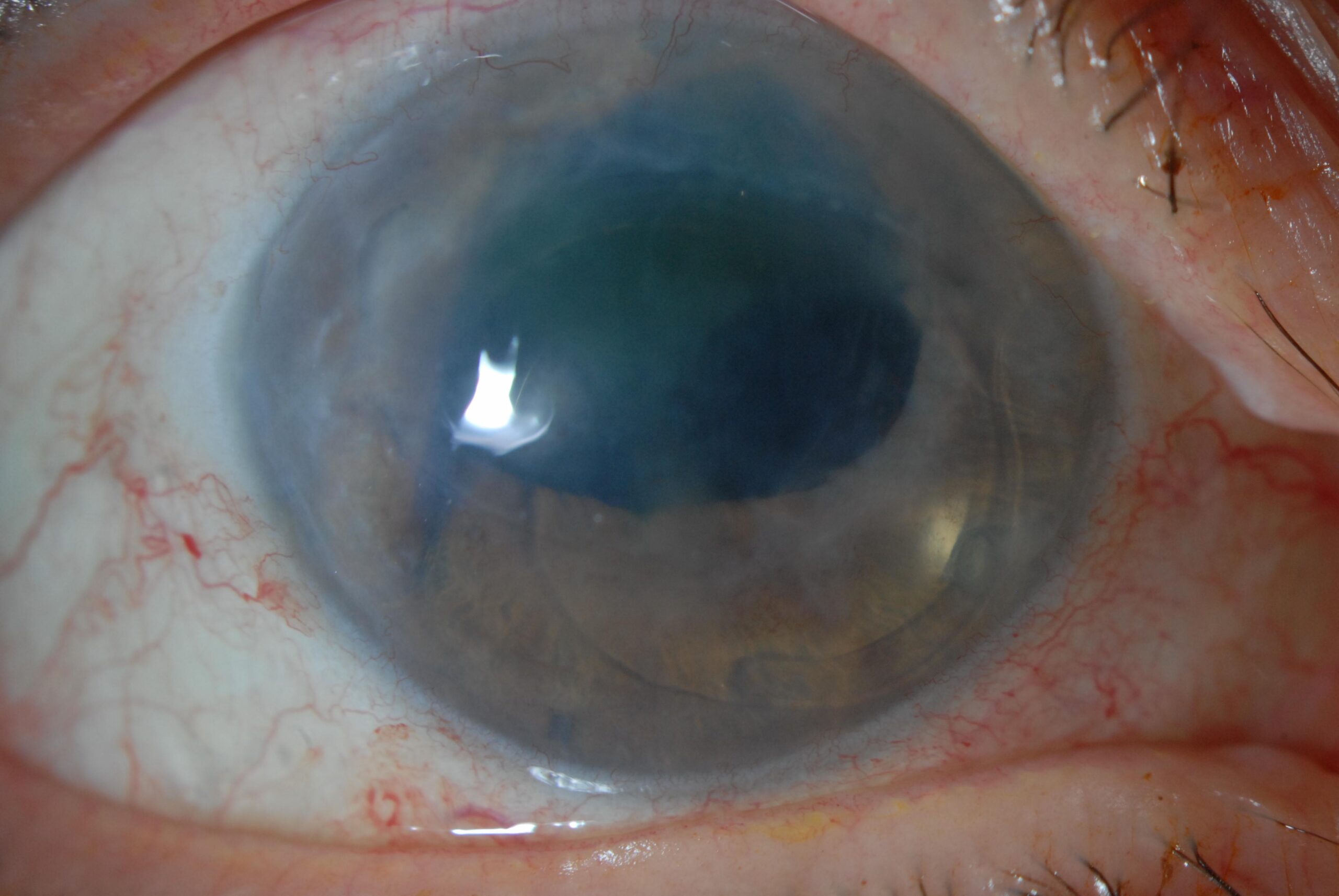 Clinical eye photograph illustrating Corneal Endothelial Cell Therapy