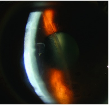 Clinical eye photograph illustrating Corneal Graft Failure