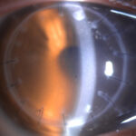 Clinical eye photograph illustrating Corneal Graft Rejection Signs