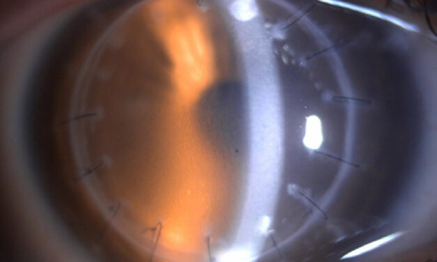 Corneal Graft Rejection: Reading the Warning Signs Before the Graft Fails