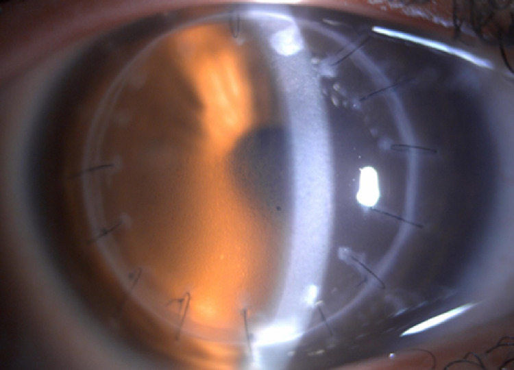 Corneal Graft Rejection: Reading the Warning Signs Before the Graft Fails