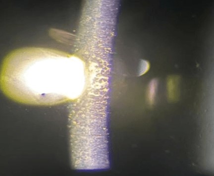Corneal Guttae: The Earliest Sign of a Failing Endothelium