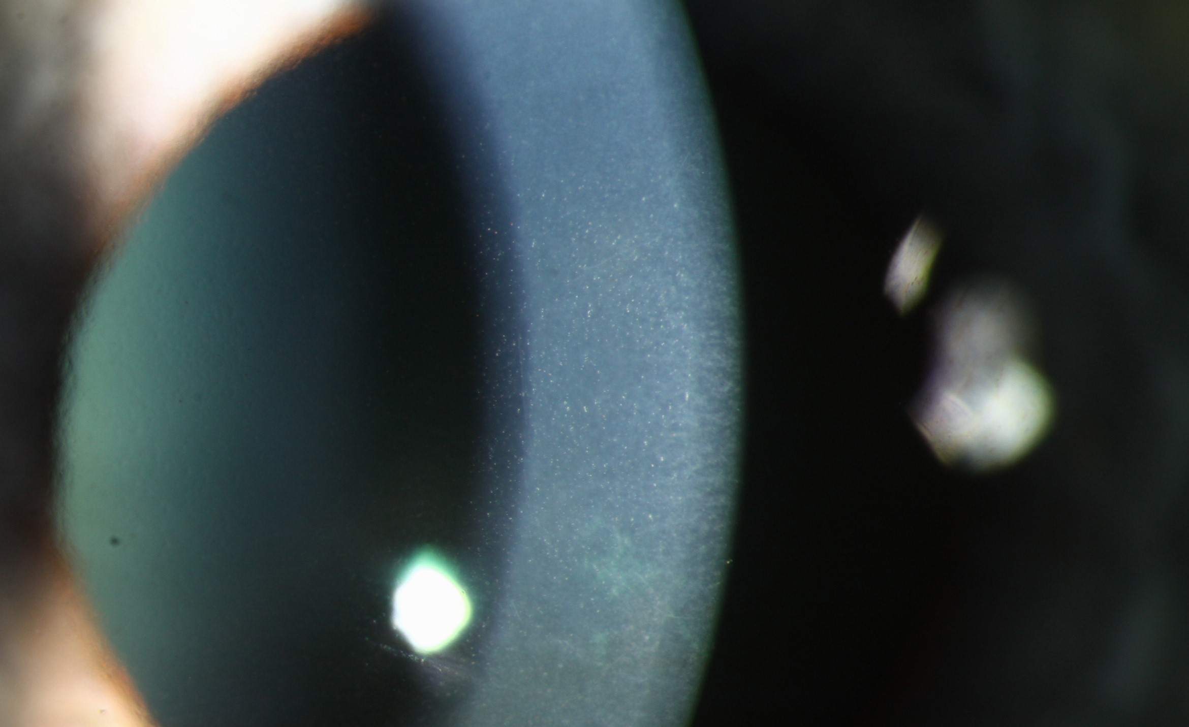 Clinical eye photograph illustrating Corneal Guttae Early Detection