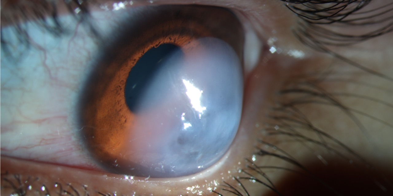 Acute Corneal Hydrops: When a Keratoconic Cornea Suddenly Fills With Fluid