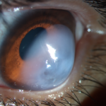 Clinical eye photograph illustrating Corneal Hydrops Acute Keratoconus