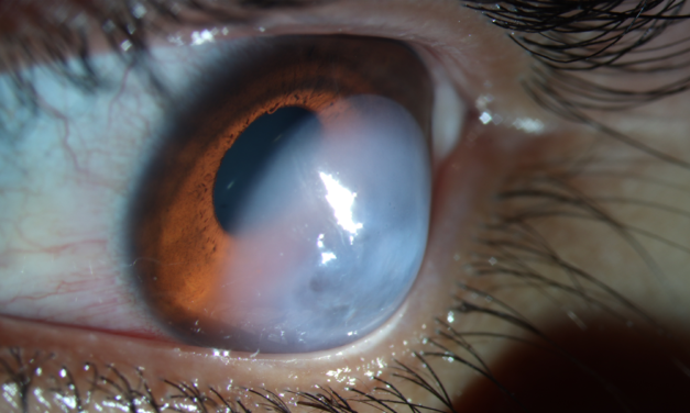 Acute Corneal Hydrops: When a Keratoconic Cornea Suddenly Fills With Fluid