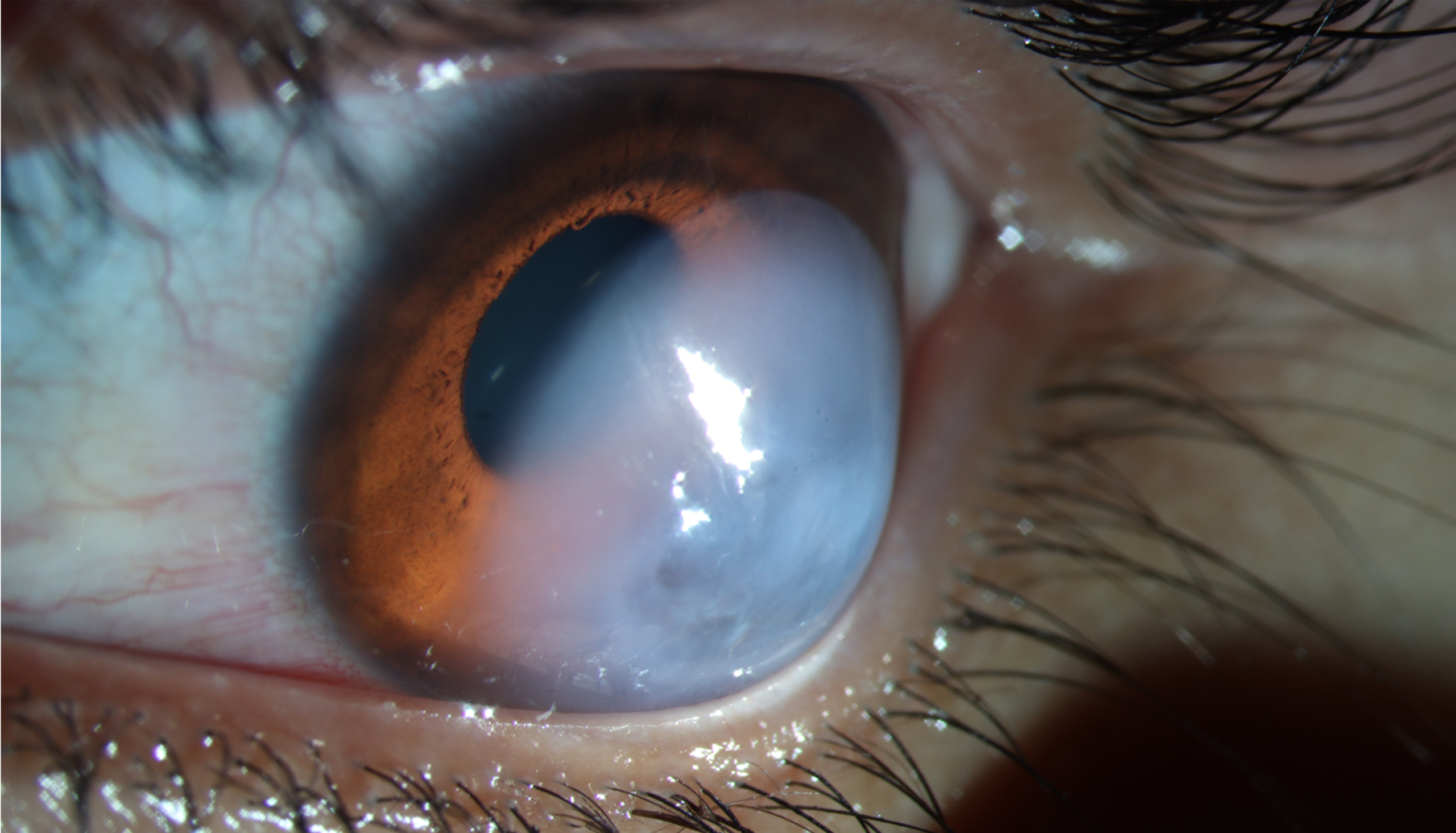 Clinical eye photograph illustrating Corneal Hydrops Acute Keratoconus