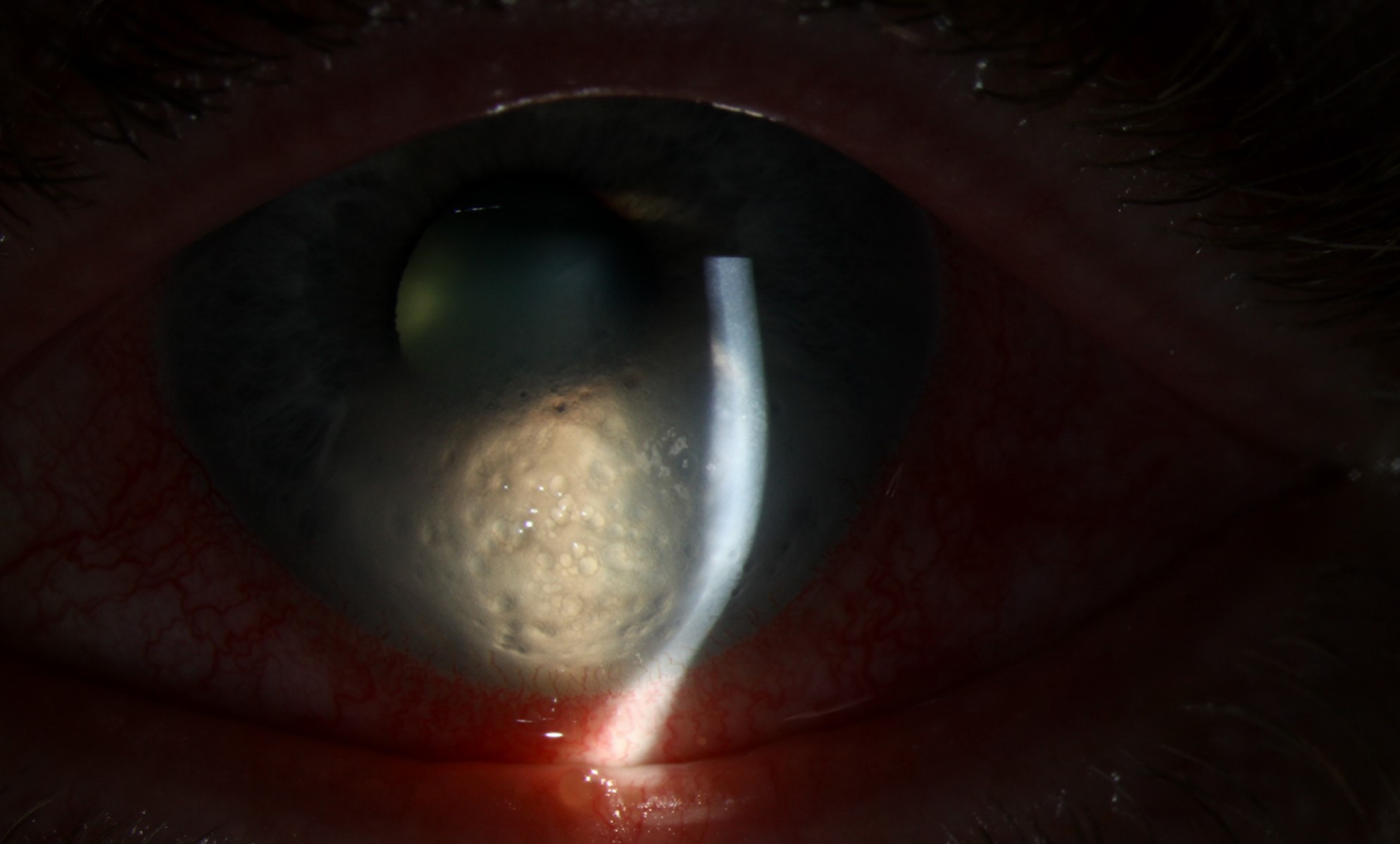 Clinical eye photograph illustrating Corneal Hydrops Acute Keratoconus