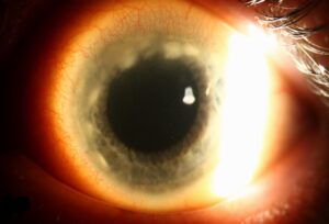 Clinical image illustrating Corneal Infiltrates (White Spots on Cornea)