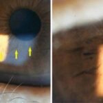 Clinical eye photograph illustrating Corneal Iron Lines Differential Diagnosis